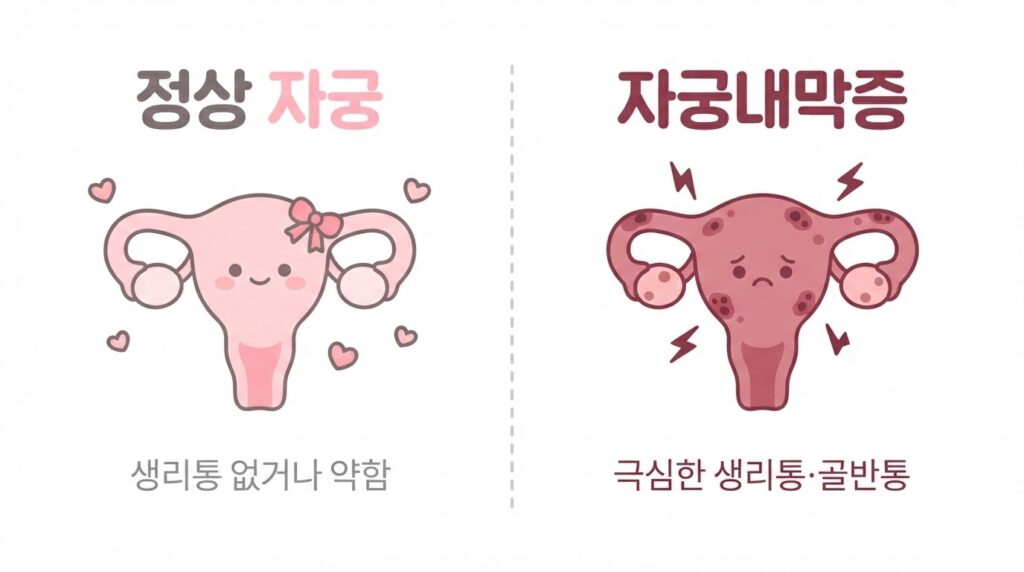 정상 자궁과 자궁내막증을 귀여운 자궁 캐릭터로 비교한 인포그래픽 — 건강한 핑크 자궁 vs 병변 있는 갈색 자궁과 한글 설명
