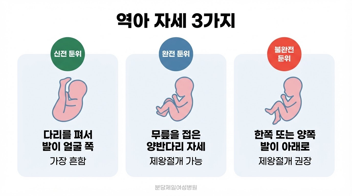 역아 자세를 다리를 편 신전 둔위, 무릎을 접은 완전 둔위, 발이 아래를 향한 불완전 둔위 세 가지로 나누고 각 유형의 빈도와 분만 방법 판단을 아이콘 카드로 정리한 한글 인포그래픽