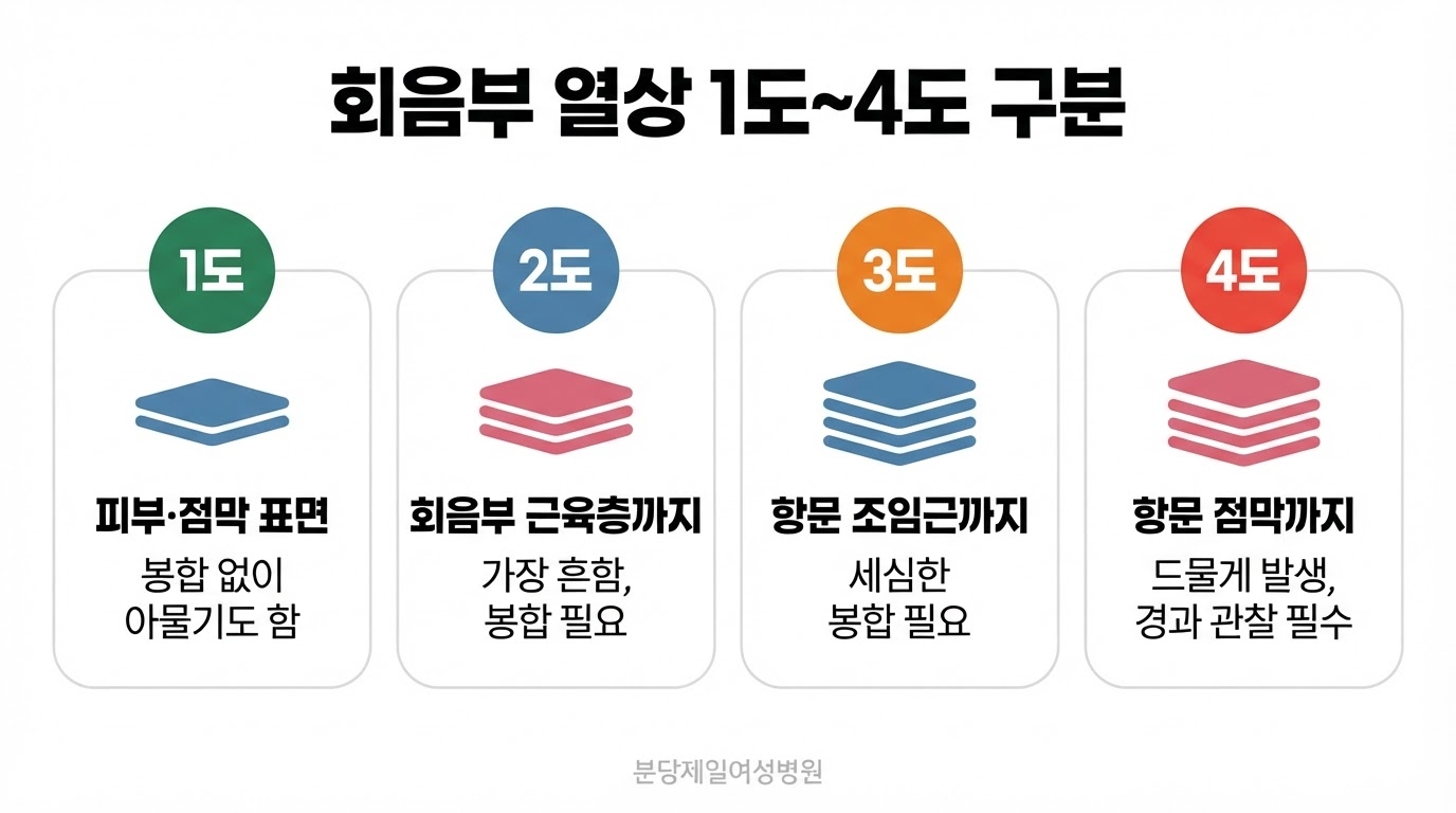 회음부 열상을 1도 피부·점막 표면, 2도 회음부 근육층까지, 3도 항문 조임근까지, 4도 항문 점막까지 네 단계로 나누고 각 단계의 봉합 필요 여부를 층 구조 아이콘으로 정리한 한글 인포그래픽
